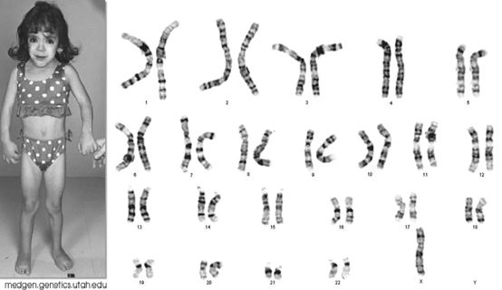 Missing chromosome disease